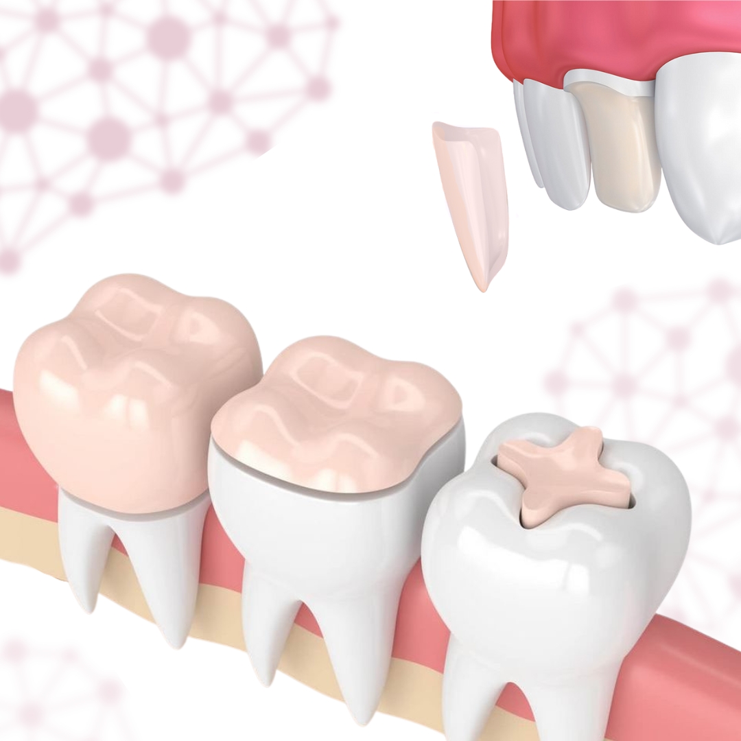 Diferencia entre corona dental e incrustación